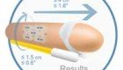 Penis Enlargement Results